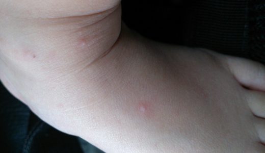 【手足口病】1歳3ヶ月赤いブツブツが！手足口病にかかった時の経験談（症状・完治まで）